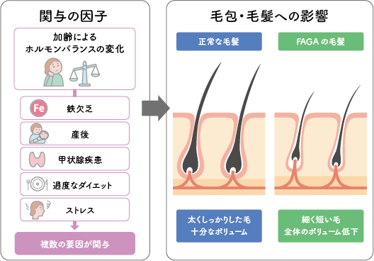 FAGA（女性型脱毛症・びまん性脱毛）